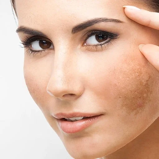 O que você precisa saber sobre o melasma